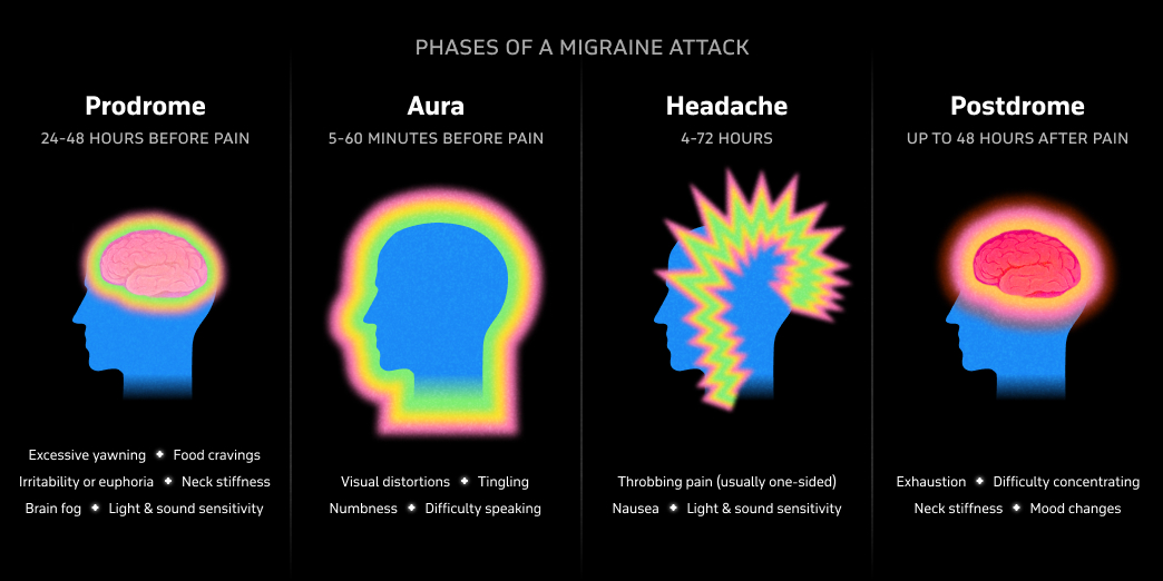 The four phases of a migraine attack: prodrome, aura, headache, postdrome